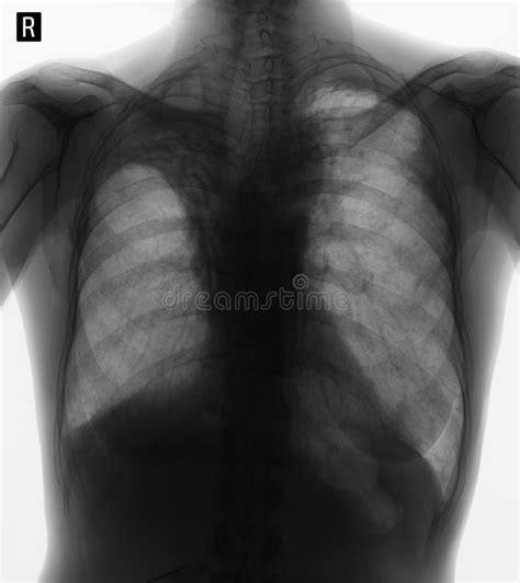 X Ray Of The Lungs Hemothorax Rib Fractures Of The Left Stock Photo