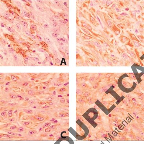 A Tumor Showing Sma Positivity B Epithelioid Cells Showing Strong