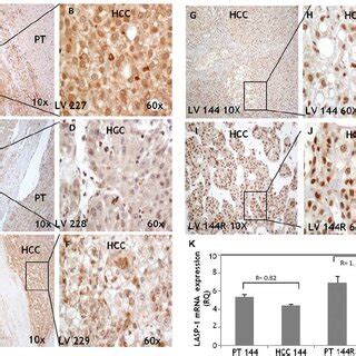 The Expression Of Lasp Mrna By Qpcr In Hcc And Pt Tissues From The