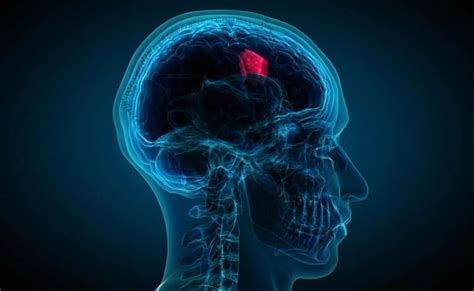 Brain Tumor: Some of the symptoms and signs to look out for