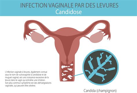 Comment Soigner Une Candidose Information Hospitalière Lexique Et