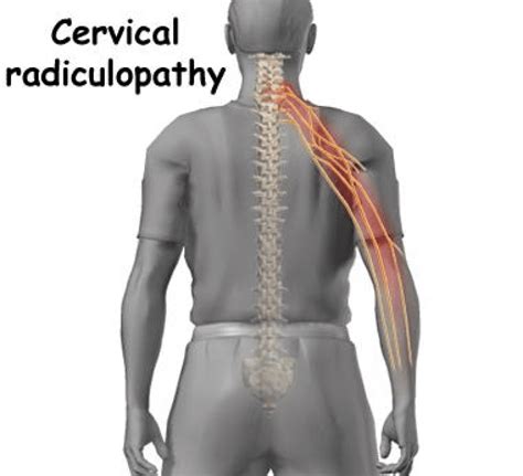 Cervical Radiculopathy In Cervical Radiculopathy Radiculopathy My Xxx