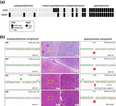 Tert Promoter Mutations And Copy Number Alterations In 50 Pfse Tumors Download Scientific