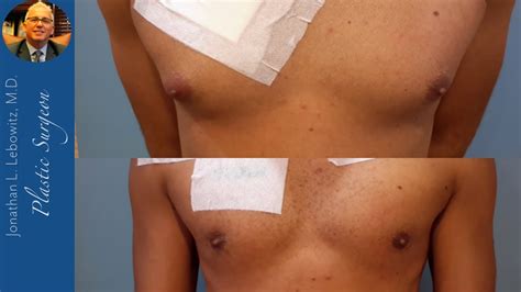 Before After Gynecomastia Gland Removal By Dr Lebowitz Long Island