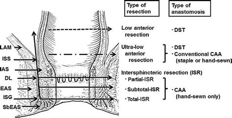 Different Types Of Rectal Resectional Operations Shirouzu Et Al