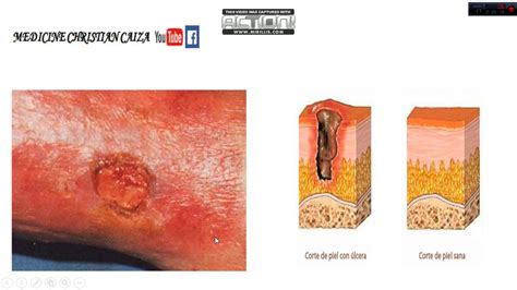 Lesiones Cutaneas