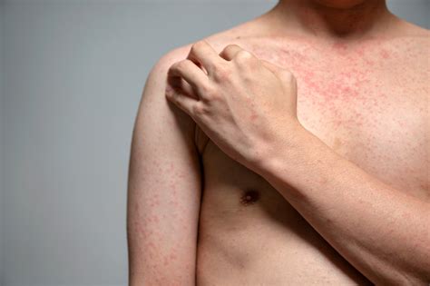 Amid Rising Measles Cases A New Generation Of Doctors Is Being Taught How To Spot The Disease