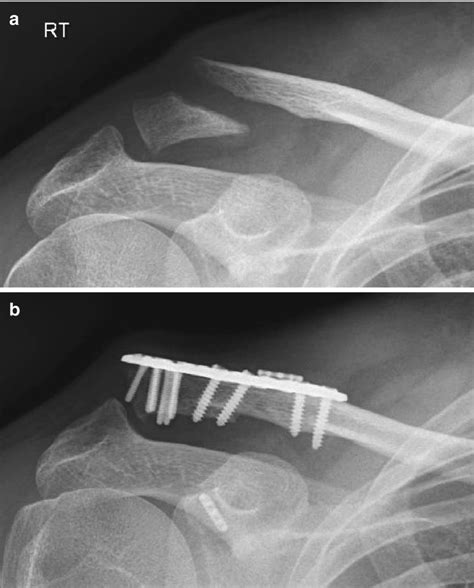 Fractures Musculoskeletal Key