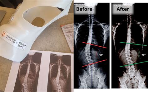 Tratamento Para Escoliose Colete D Nosso Blog