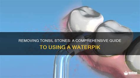 Removing Tonsil Stones A Comprehensive Guide To Using A Waterpik MedShun