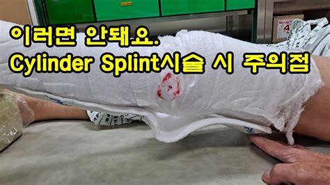 Cylinder Splint Youtube