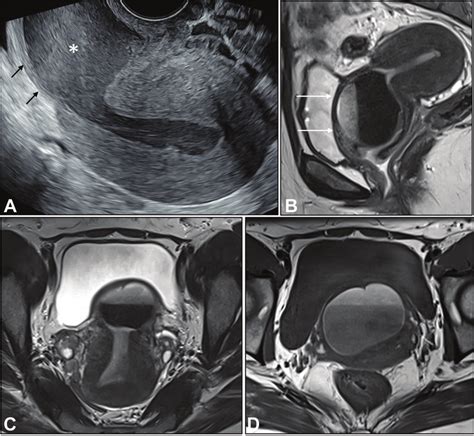 Transvaginal Ultrasound Image A Shows A Retroflexed Uterus With Download Scientific Diagram