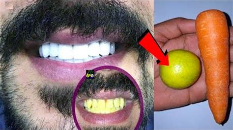 Teeth Whitening At Home In 3 Minutes How To Naturally Whiten Your Yellow Teeth 100 Effective