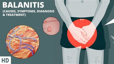 The Secrets To Breaking Free From Balanitis Your Complete Guide To