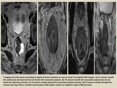 Presentation Radiological Imaging Of Anal Carcinoma Ppt