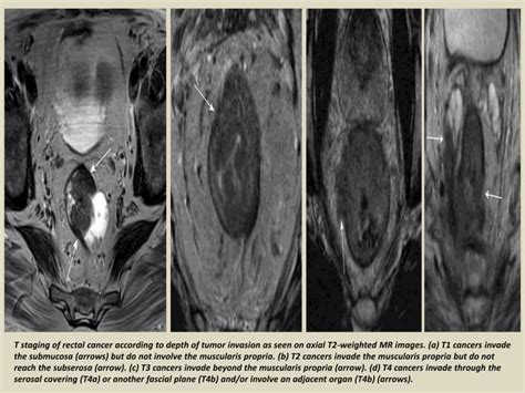 Presentation1 Radiological Imaging Of Anal Carcinoma Ppt