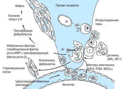 Экзогенный аллергический и фиброзирующий альвеолит легких, симптомы ...