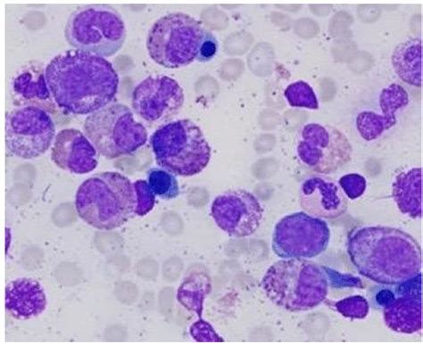 Fip1l1 Pdgfra Positive Chronic Eosinophilic Leukemia A Case Report Ijpo