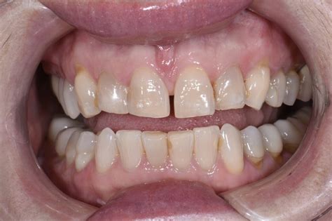 Veneer Margin Design And Position Duchenne Smile