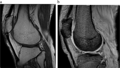 Prepatellar Continuation Rupture Report Of An Unusual Case The Knee