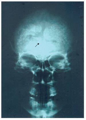 Hiperostosis frontal interna síndrome de Morgagni a propósito de un