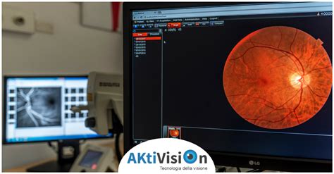 Distacco Di Retina I Sintomi Da Non Sottovalutare AKtiVision