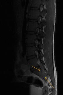 Sacral Neural Tumour-MRI - Sumer's Radiology Blog