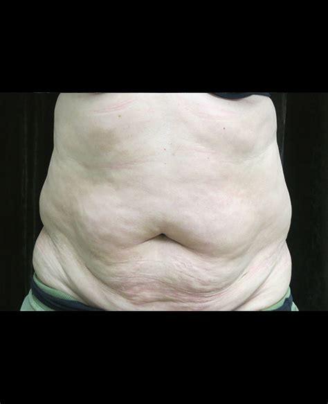 Top Pictures Tummy Tuck After C Section Pictures Excellent