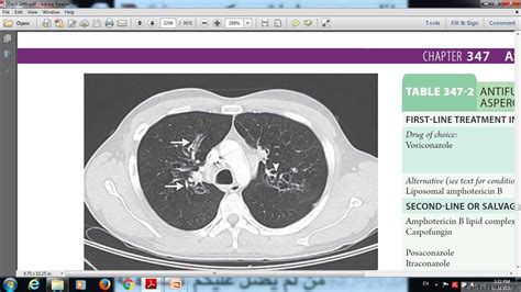 Respiratory Fungal Infections Docx D Majeed Muhadharaty