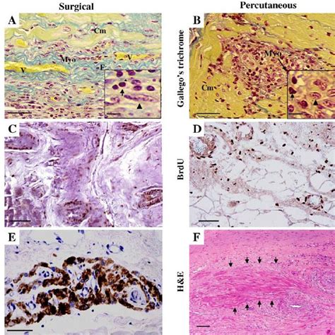 Representative Picrosirius Red Staining Of Infarct Area A B C And Download Scientific Diagram