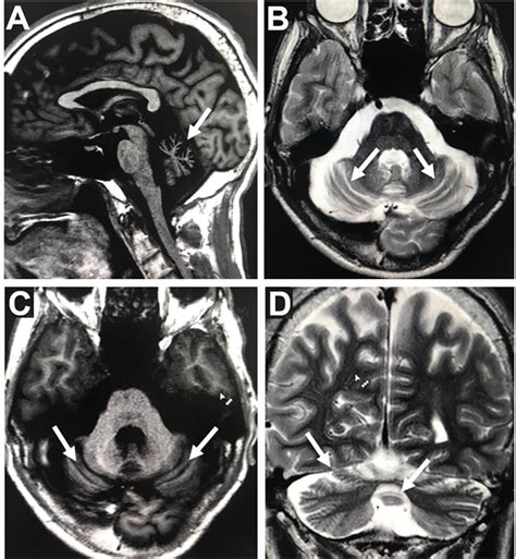 Parkinsonism Related Disorders