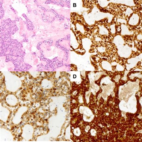 Representative Hande Stain 1a β Catenin Immunostaining 1b Cd 10