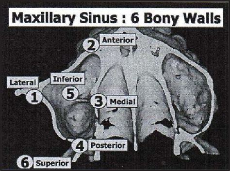 Anatomical Description Of Maxillary Sinus Download Scientific Diagram