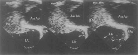 Sequence Of Echocardiographic Frames Showing Right To Left Shunt