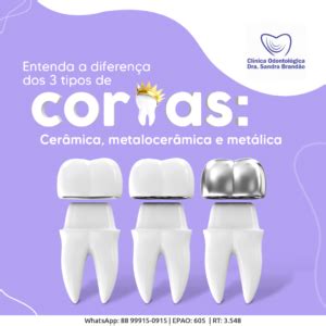 Entenda A Diferen A Dos Tipos De Coroas Cer Mica Metalocer Mica E