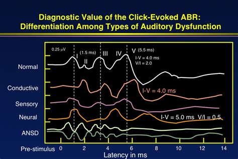 Update On Auditory Evoked Responses Value Of Chirp Stimuli In ABR ASSR