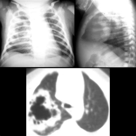 Newborn With An Echogenic Right Chest Mass On Prenatal Ultrasound