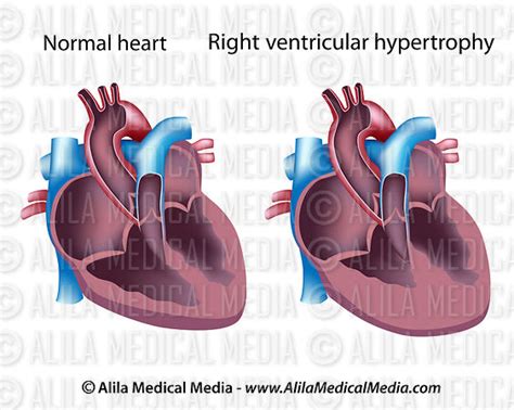 Alila Medical Media Right Ventricular Hypertrophy Medical Illustration