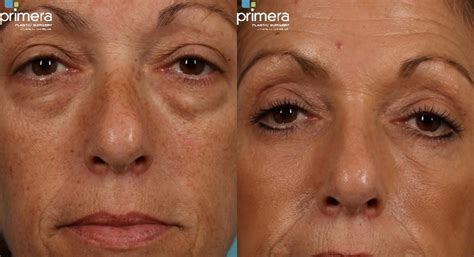 Blepharoplasty Before And After Pictures Case 274 Orlando And Tampa