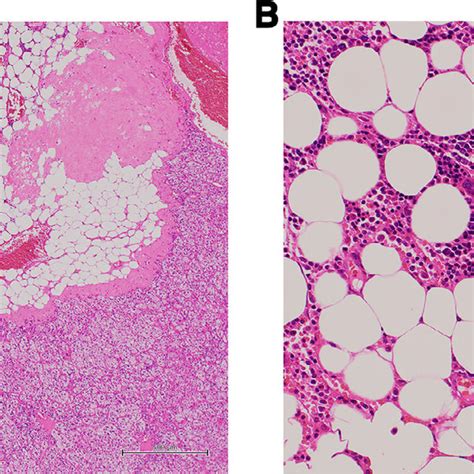 Adrenocortical Adenoma A Hematoxylin And Eosin Hande Stain Download Scientific Diagram