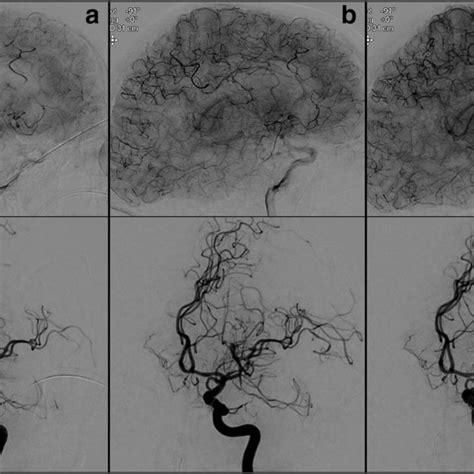 Digital Subtraction Angiography Dsa Before A After Download Scientific Diagram