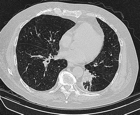 Ultra Low Dose Ct Chest Radiology Sa Hot Sex Picture