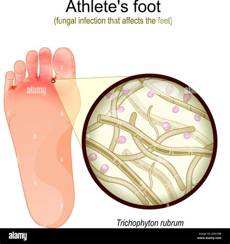 Trichophyton rubrum fungus Stock Vector Images - Alamy