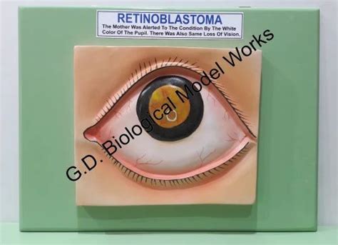 Retinoblastoma Pathology Model At Rs 2500 पैथोलॉजी मॉडल In Ambala