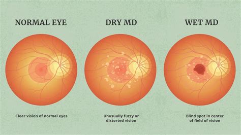 The Latest Advancements In The Treatment Of Age Related Macular