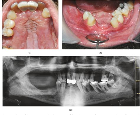 Langerhans Cell Histiocytosis Jaw