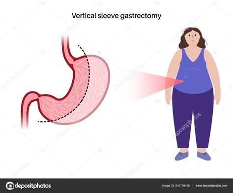 Gastrectom A De Manga Laparosc Pica Vector Gr Fico Vectorial Pikovit