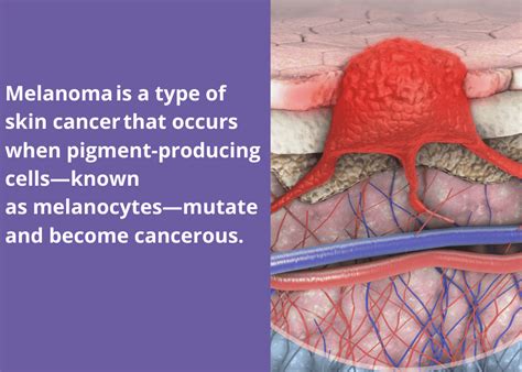 Melanoma 101 Aim At Melanoma Foundation