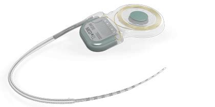 Study Shows that Improved Cochlear Implant Device Allows Safe MRI in Children without Discomfort ...