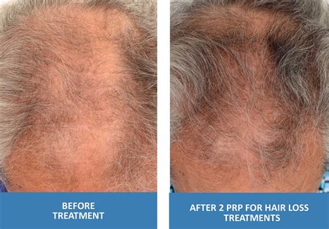 Prp For Hair Loss Platelet Rich Plasma In Springfield Missouri